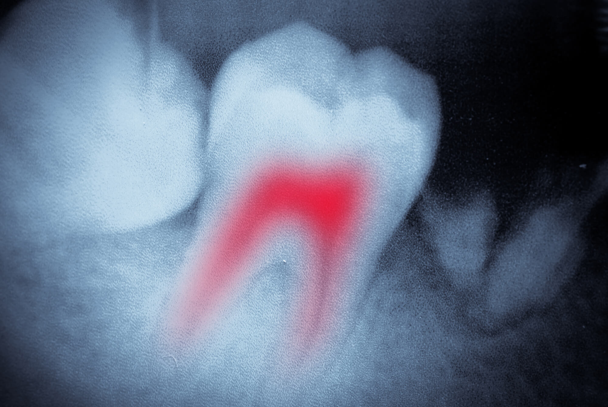 inflamed tooth that needs root canal treatment in 23226
