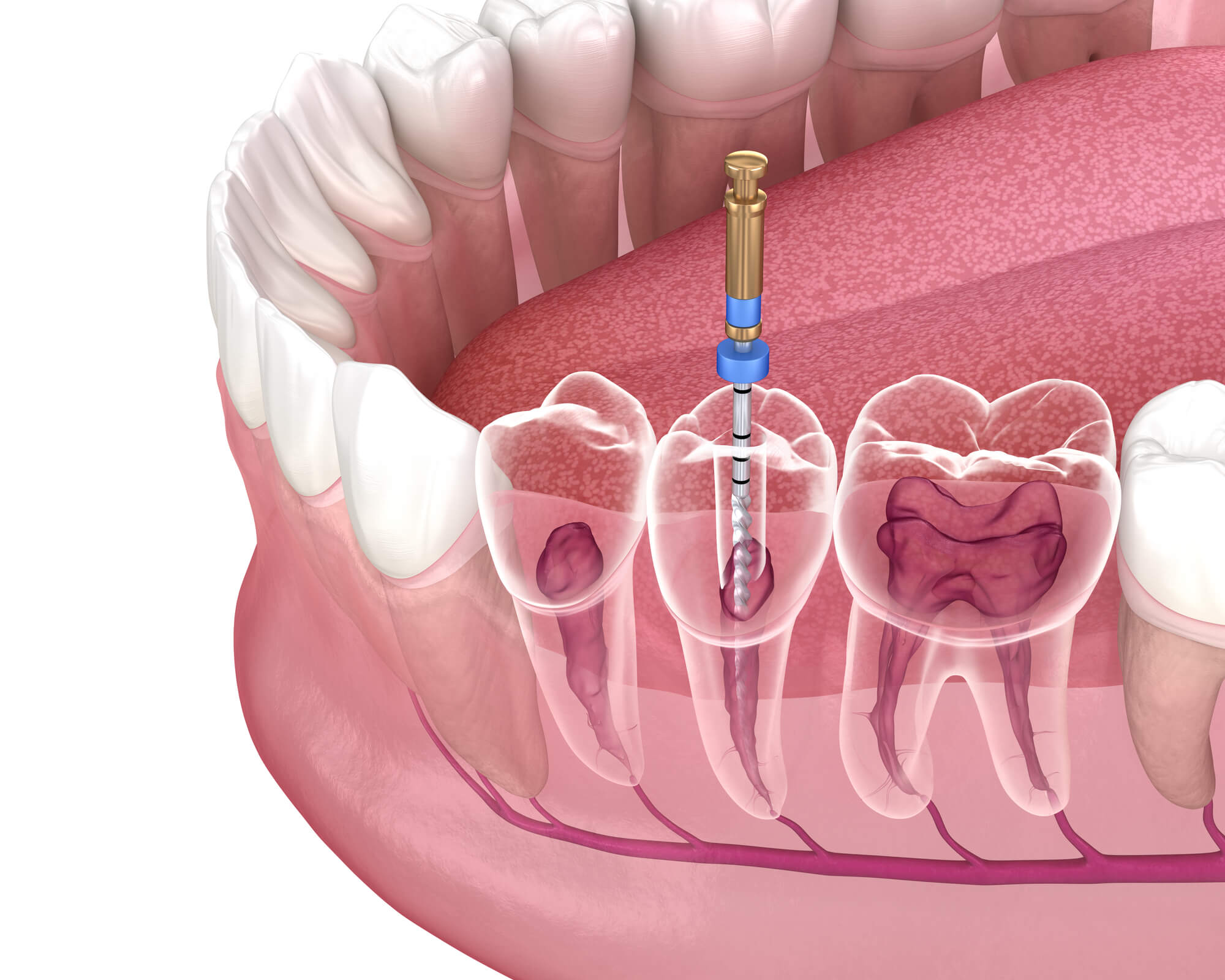 3D image of a root canal in Midlothian