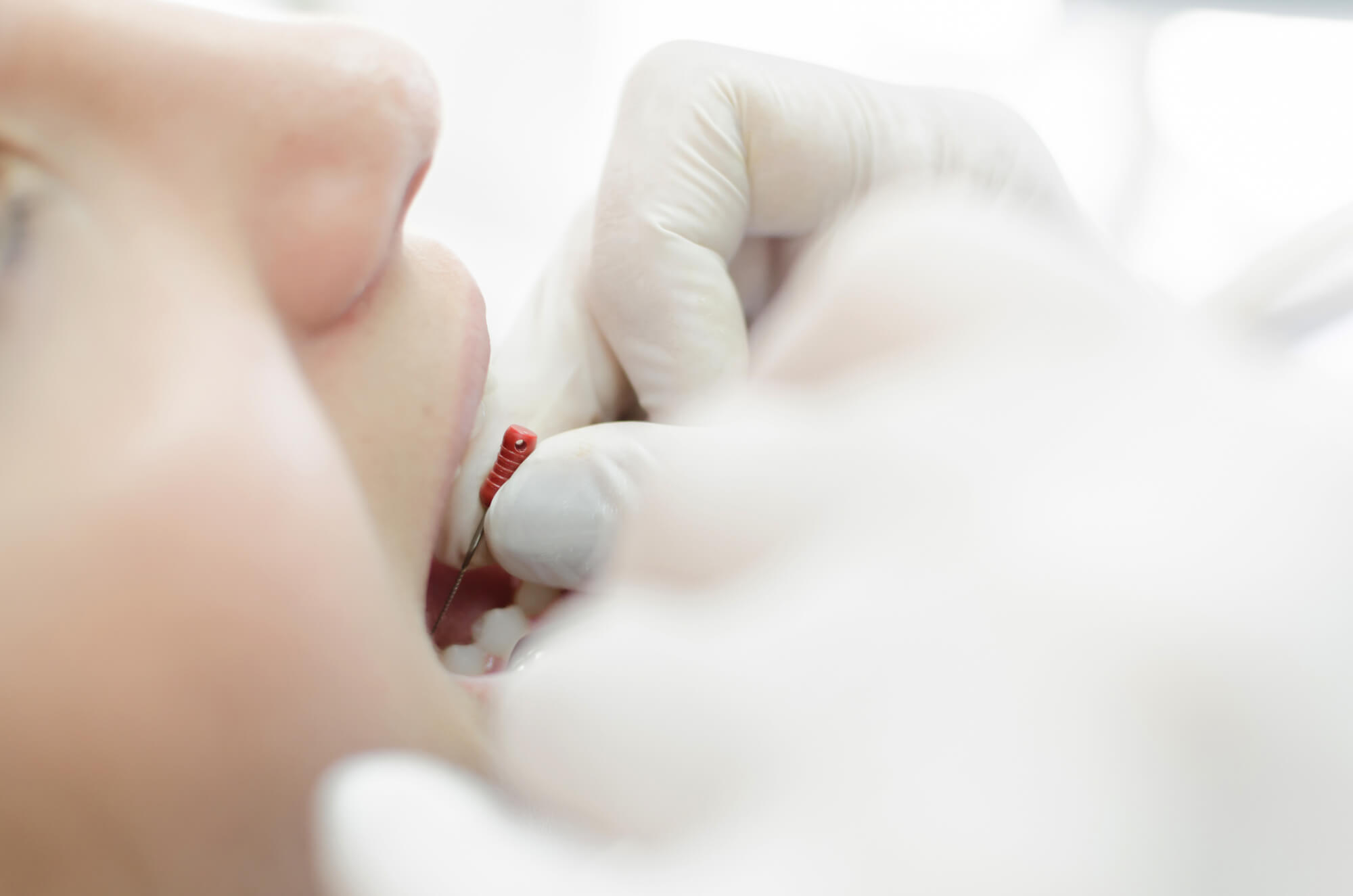 Endodontist in Richmond VA using an endodontic file