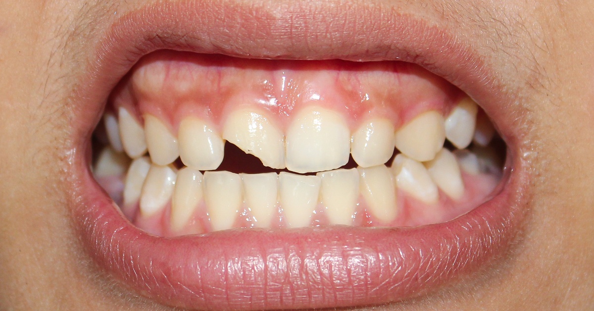 A close-up of an open mouth revealing the teeth, with one front tooth severely cracked and nearly half missing.
