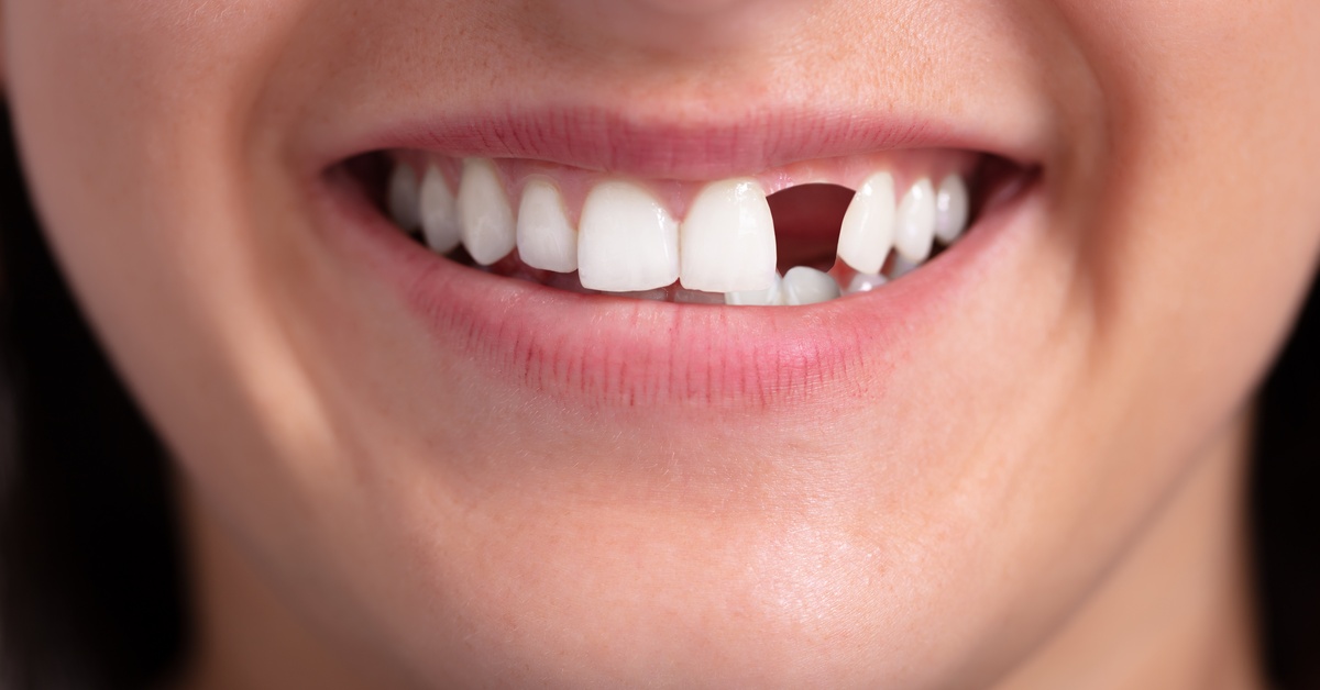 A close-up of a smiling woman with dark hair, showing a missing lateral incisor on the top row of her teeth.