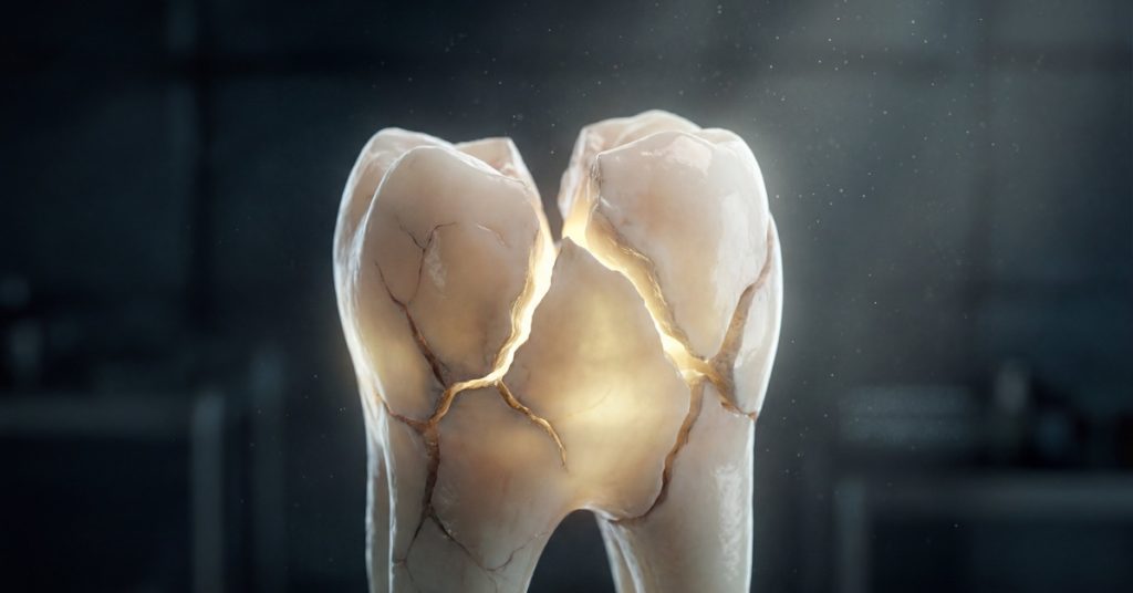 A close-up of a tooth with visible cracks and damage on the enamel surface against a blocky black background.