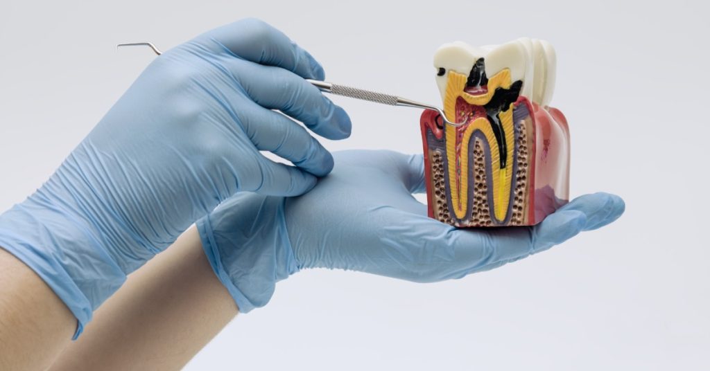 A pair of gloved hands holding a tooth cross section model showing inner layers and visible cavity areas in detail.