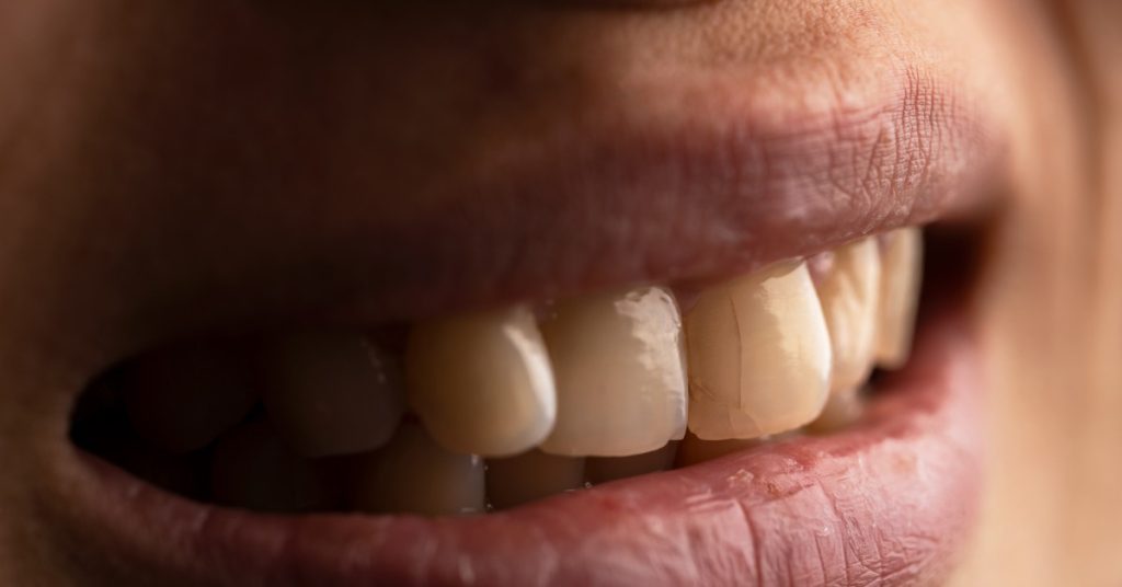 A close-up of a person's mouth showing front teeth with visible cracks and lips surrounding the teeth.