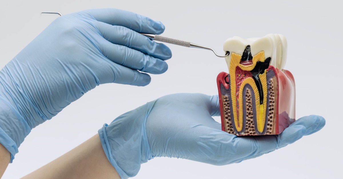 A blue-gloved hand holding a tooth anatomy model while another hand points a dental probe at the crown.