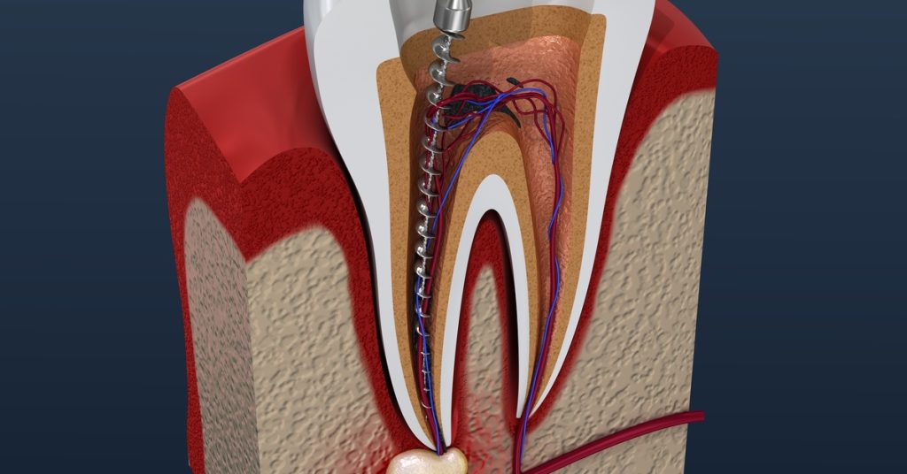 A 3D tooth cross section with a metal drill entering a root canal beside red gums and visible nerves.