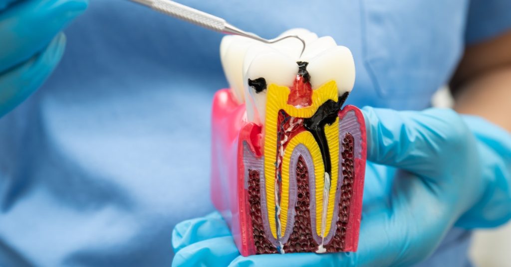 A gloved person holding a tooth model with exposed roots, decay markings, and a metal dental pick near it.