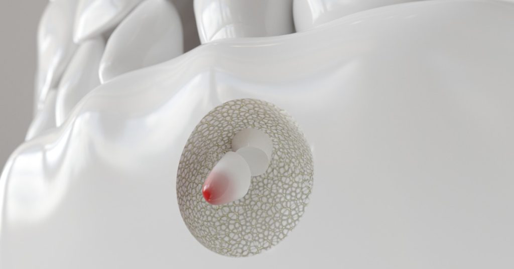 A 3D dental illustration showing white teeth, jaw tissue, and a root tip area marked with red coloring.