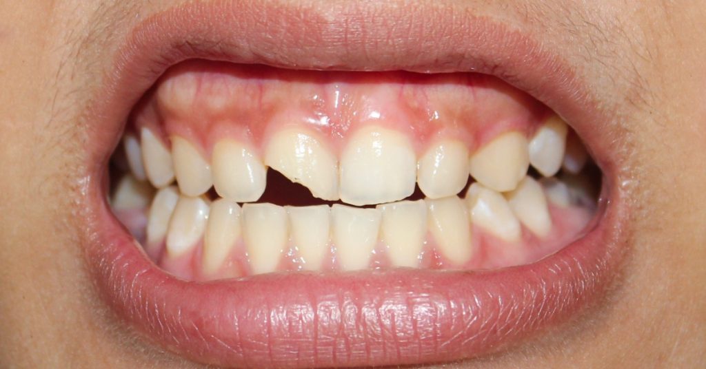 A mouth with parted lips, visible teeth, and a chipped front tooth among several uneven teeth in bright light.