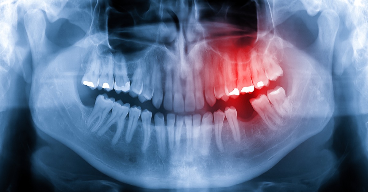 A blue dental x-ray of teeth and jaw with a red highlighted area around upper and lower molars on one side.